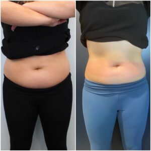 Cryoslimming before and after
