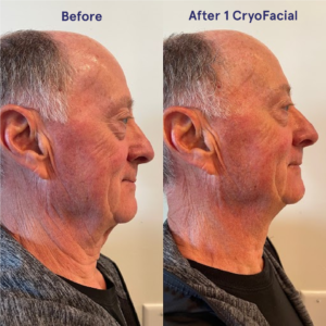 Cryofacial before and after comparison
