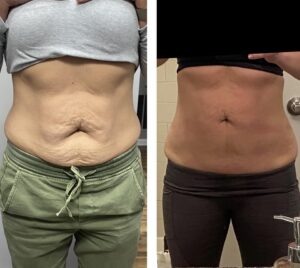 Cryoslimming before and after